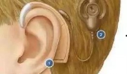 网友爆料耳蜗钉视频大全,网友爆料揭秘耳蜗植入全过程